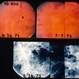 Behcet Uveitis
